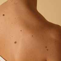 BEN VE LEKE TEDAVİSİ